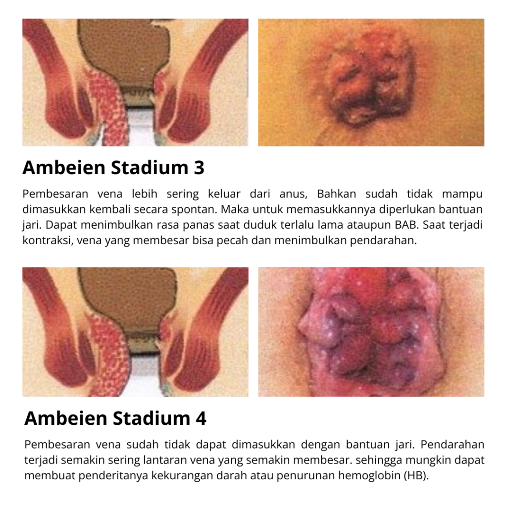 obat ambeien