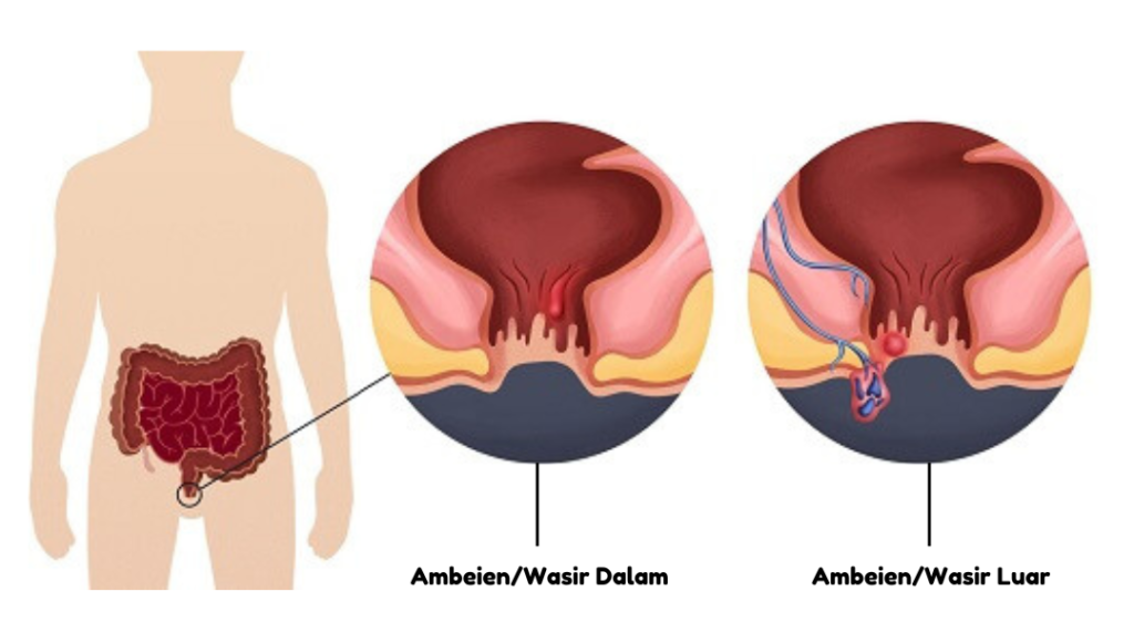 obat ambeien, obat wasir